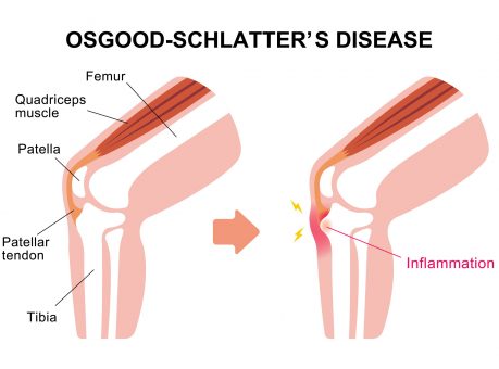 Osgood Schlatter’s Disease