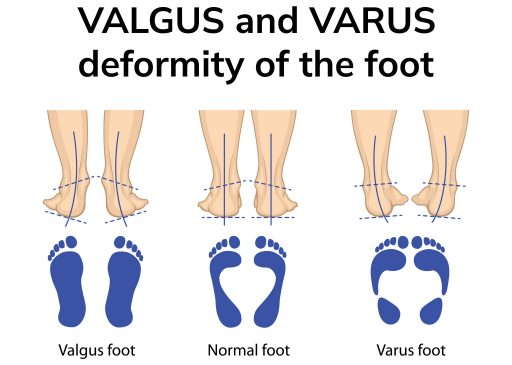 Valgus and varus
